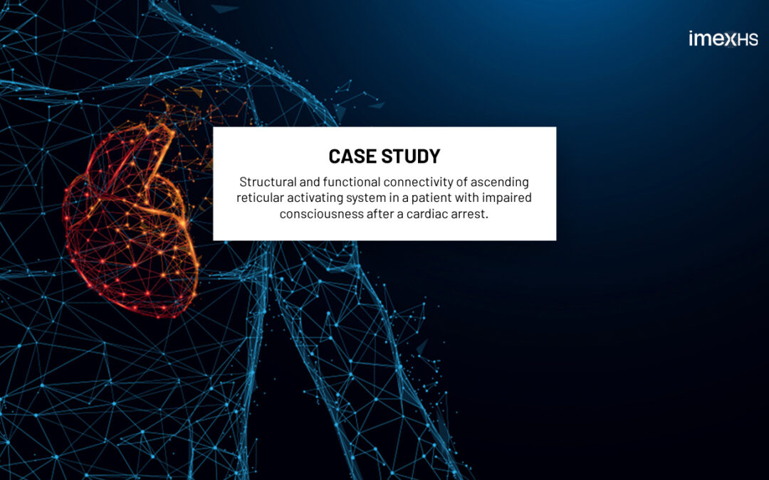 Case of Study : Structural and functional connectivity of ascending reticular activating system in a patient with impaired consciousness after a cardiac arrest.